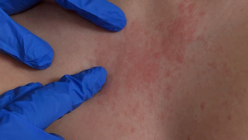 Brote de Sarampión Activa Alerta Sanitaria en Mexicali